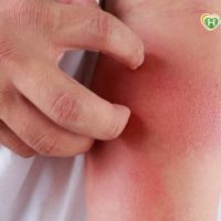 「蕁麻疹」小心愈抓愈癢! 中醫耳穴按摩助緩解