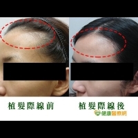 香港名模植髮際線失敗　醫：恐成娃娃頭髮型